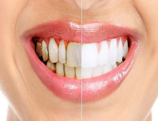  كيف نتخلص من تسوس الأسنان طبيعياً ؟ 